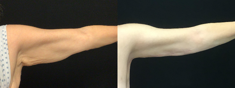 before and after arm lift