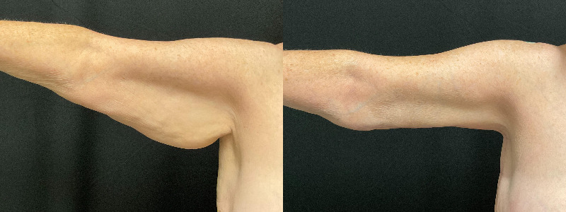before and after arm lift