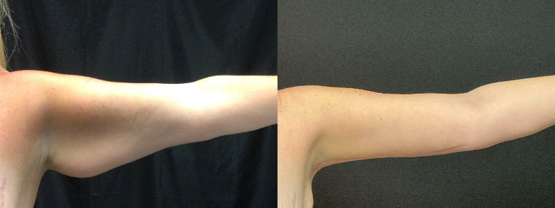 before and after arm lift
