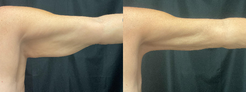before and after arm lift