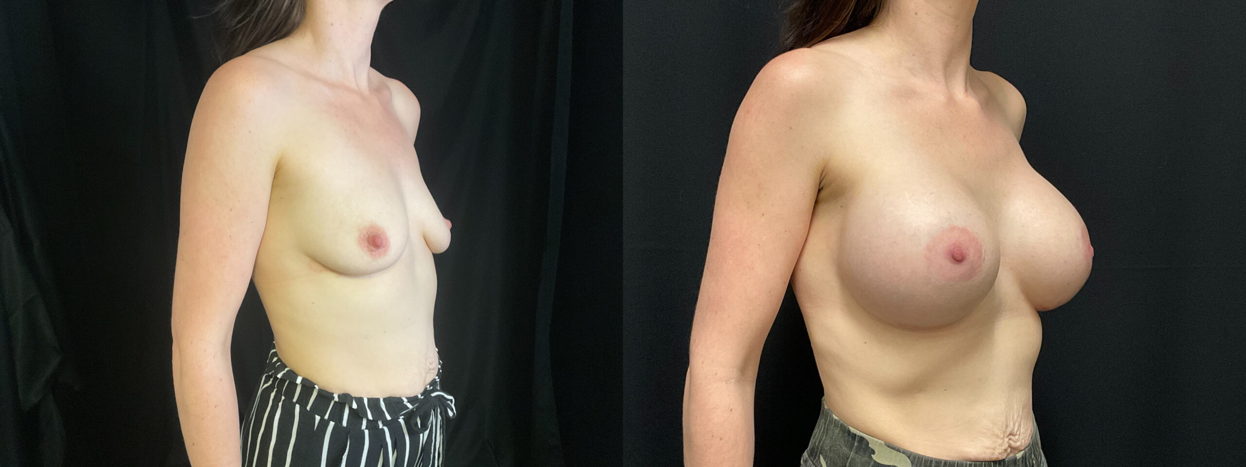 before and after breast augmentation