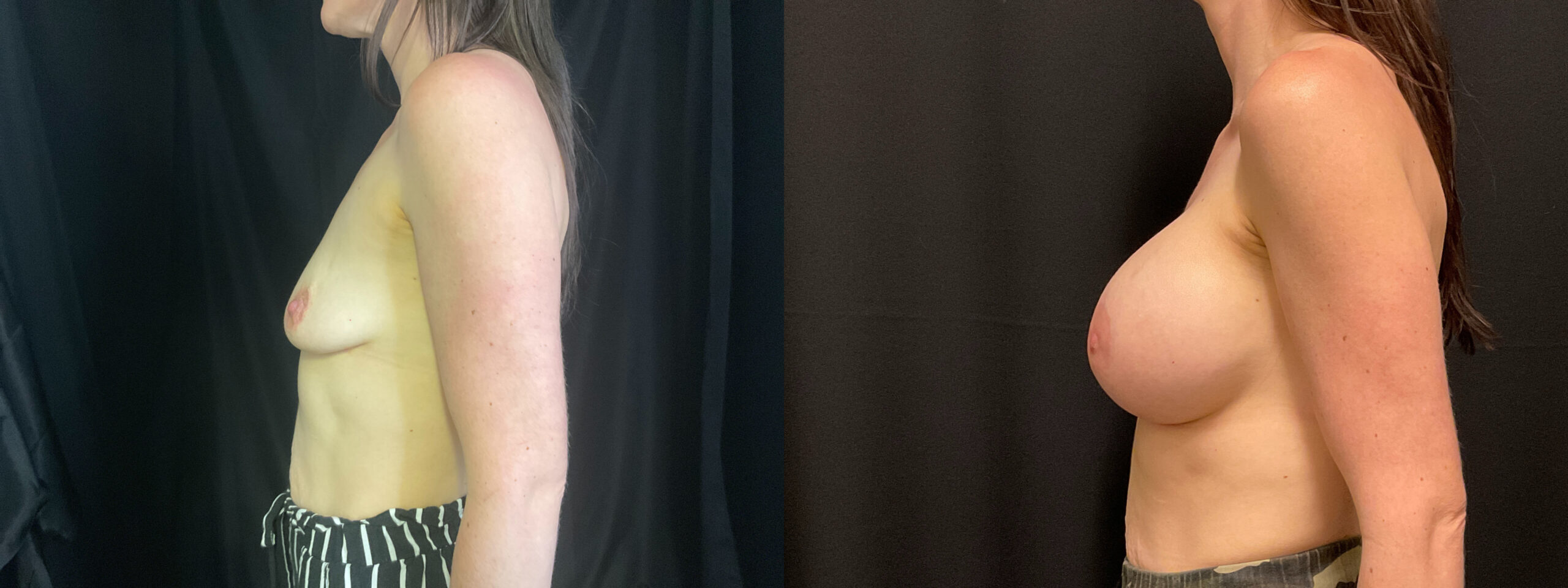 before and after breast augmentation