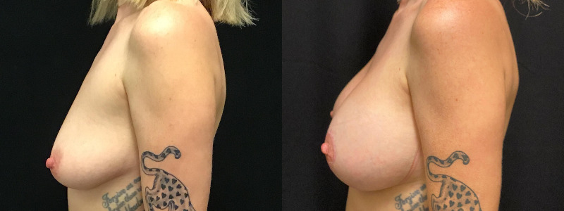 before and after breast augmentation with lift