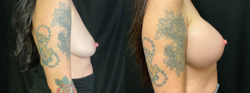 before and after breast augmentation with lift