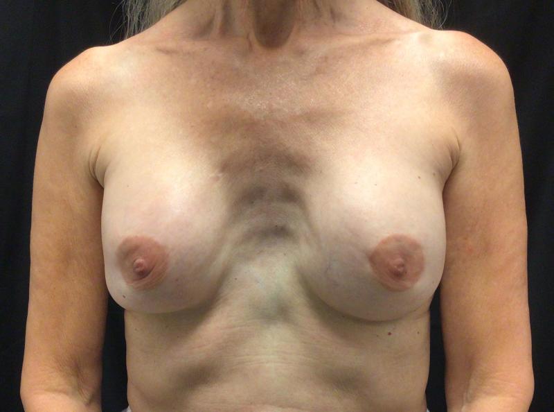before breast implant exchange