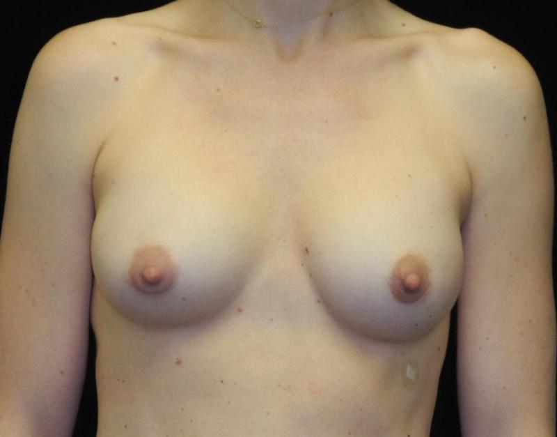 before breast implant exchange