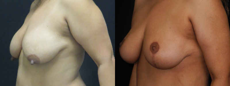 before and after breast lift