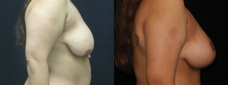 before and after breast lift
