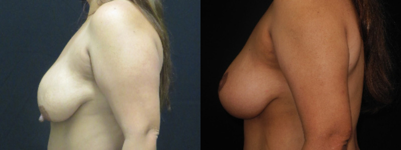 before and after breast lift
