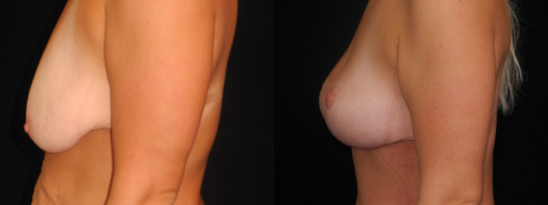 before and after breast lift