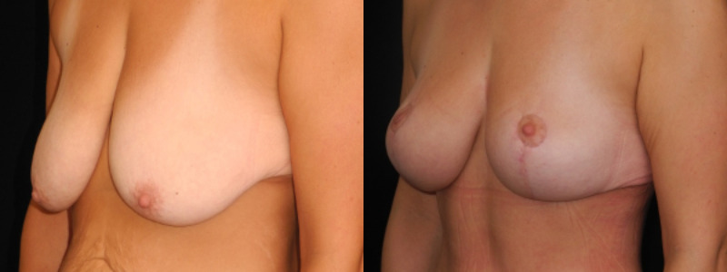 before and after breast lift