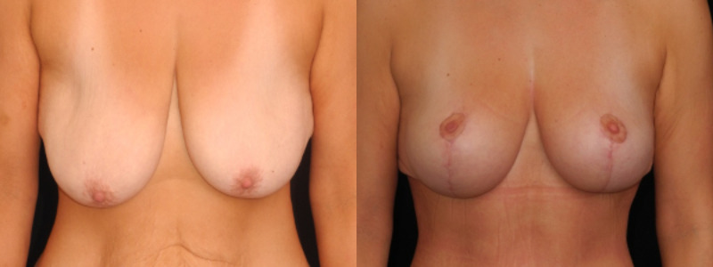 before and after breast lift