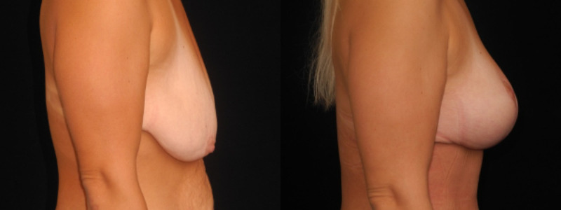 before and after breast lift
