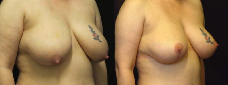 before and after breast lift