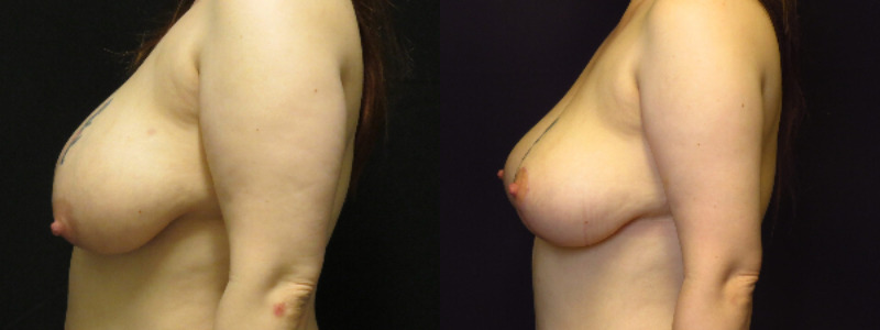 before and after breast lift