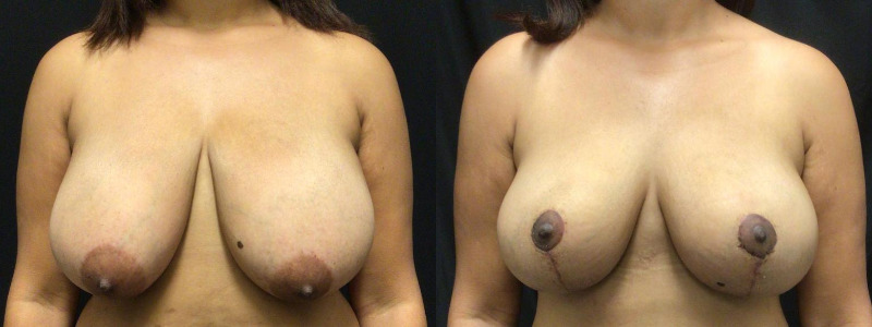 before and after breast lift