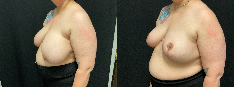 before and after breast reduction