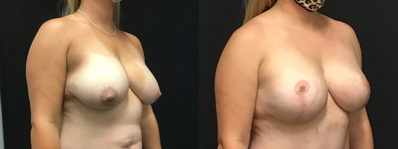before and after breast reduction