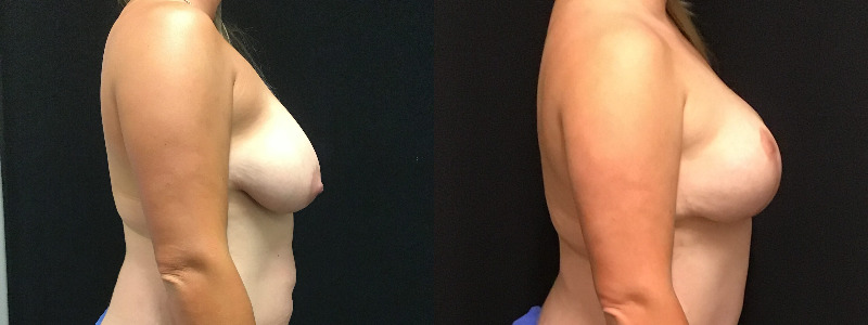 before and after breast reduction