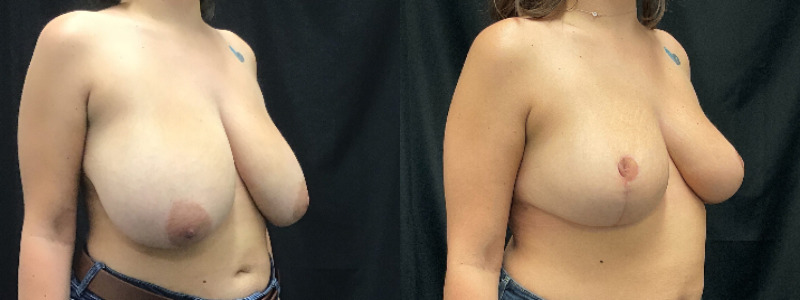 before and after breast reduction