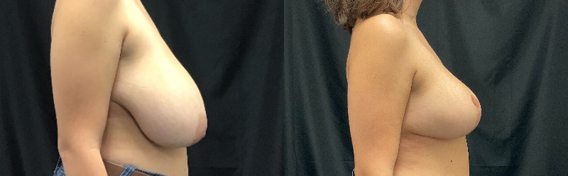 before and after breast reduction