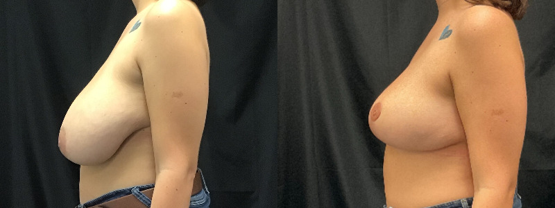 before and after breast reduction
