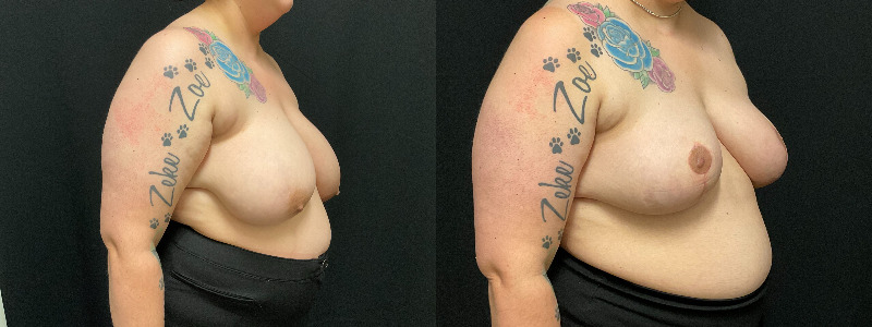 before and after breast reduction
