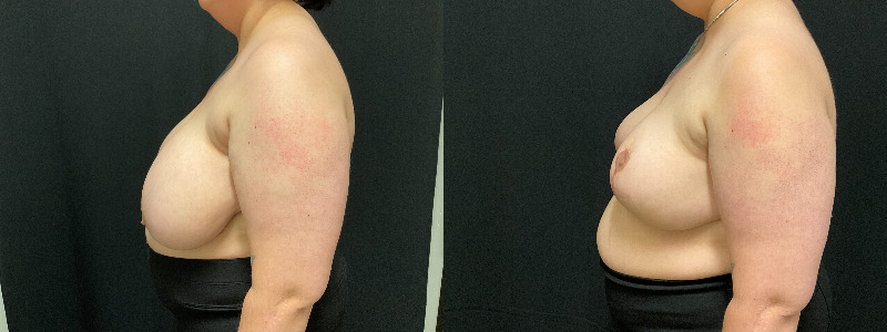 before and after breast reduction