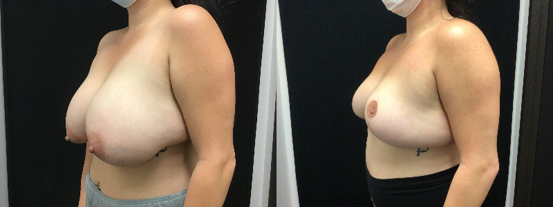 before and after breast reduction