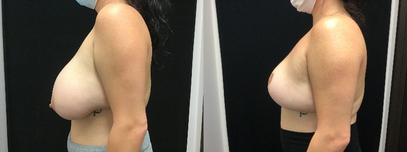 before and after breast reduction
