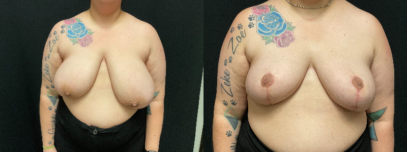 before and after breast reduction