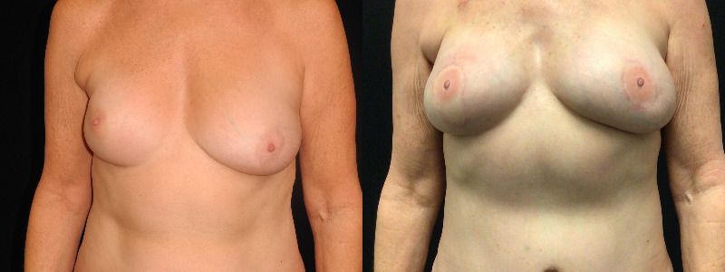 before and after diep flap reconstruction