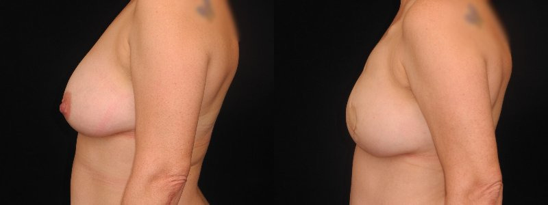 before and after diep flap reconstruction
