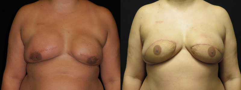 before and after diep flap reconstruction
