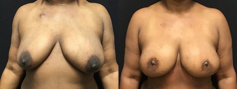 before and after diep flap reconstruction