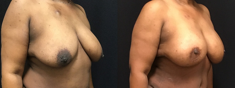 before and after diep flap reconstruction