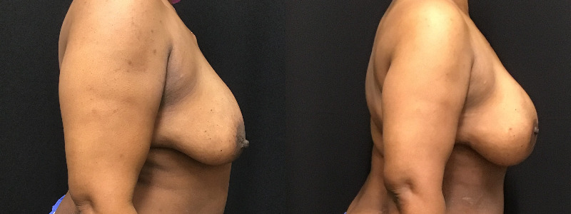 before and after diep flap reconstruction