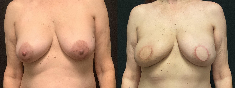 before and after diep flap reconstruction