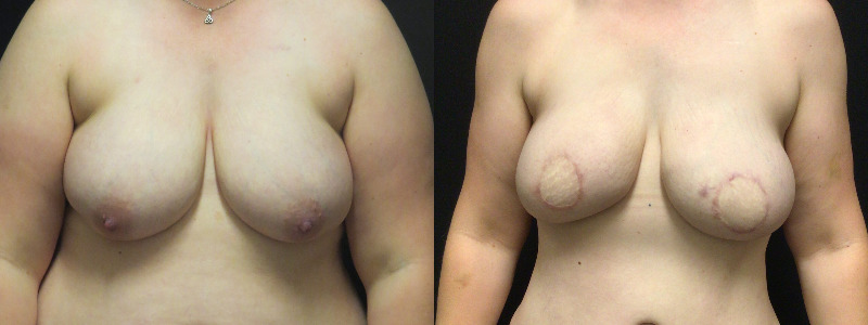 before and after diep flap reconstruction