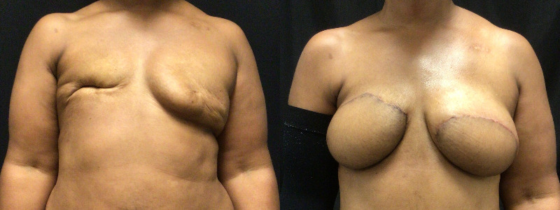 before and after diep flap reconstruction