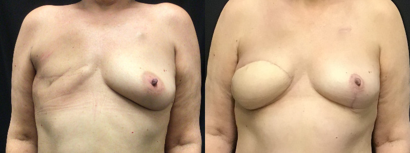 before and after diep flap reconstruction