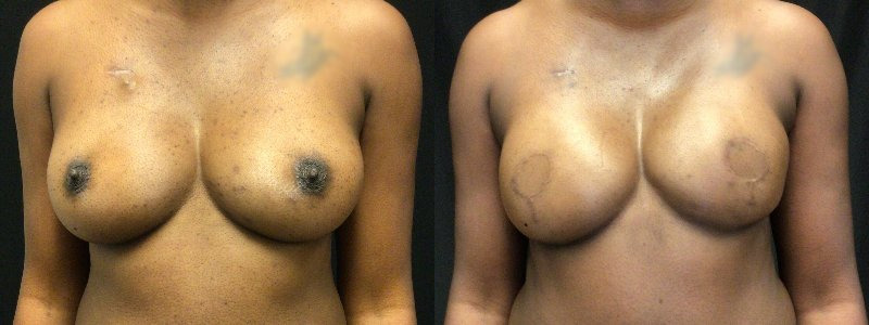 before and after diep flap reconstruction