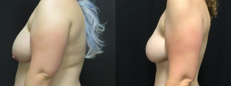 before and after diep flap reconstruction