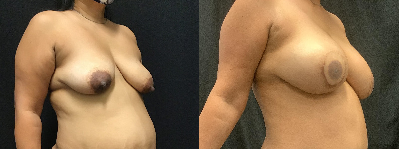 before and after diep flap reconstruction
