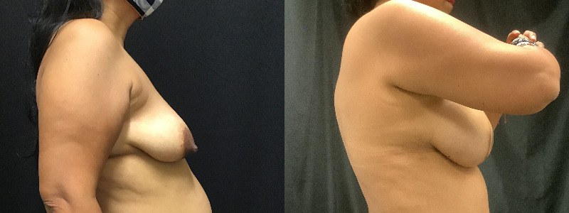 before and after diep flap reconstruction