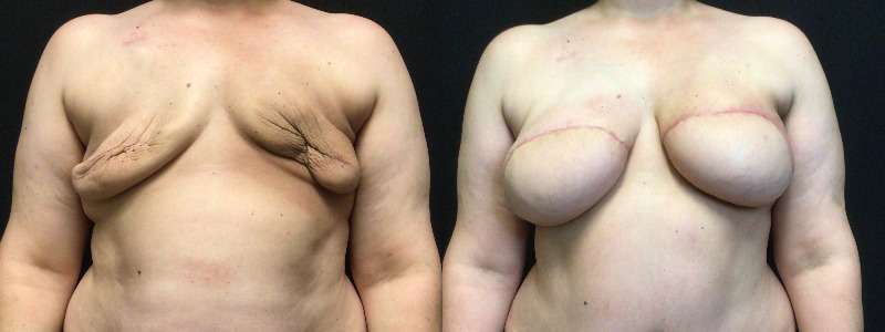 before and after diep flap reconstruction