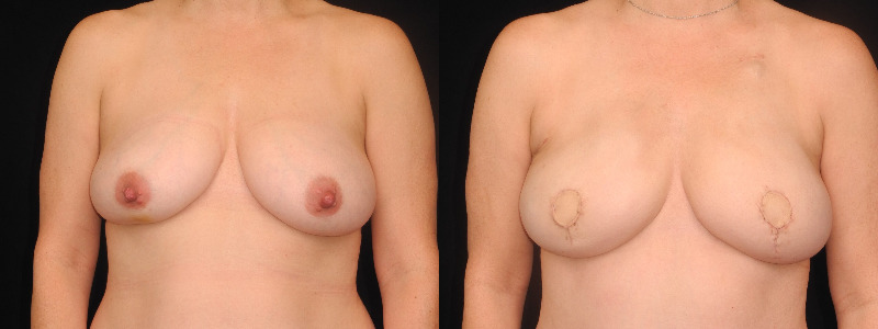 before and after diep flap reconstruction