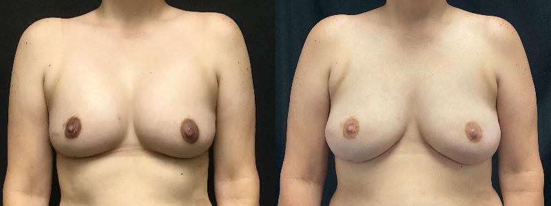 before and after implant reconstruction