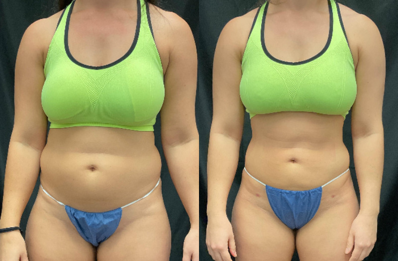before and after liposuction