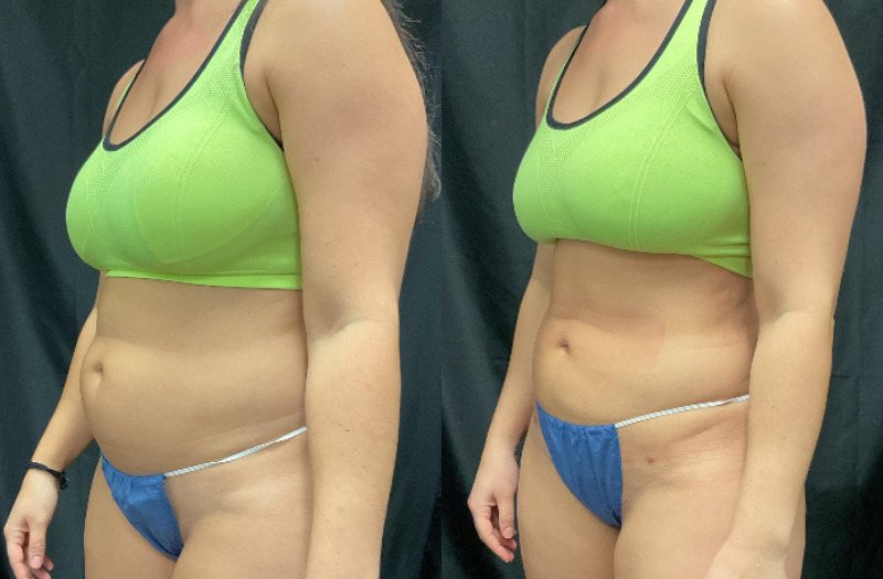 before and after liposuction